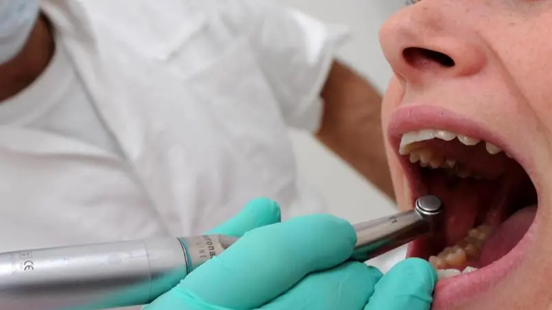 20100120-PISA- SALUTE: ADDIO TRAPANO, PER LE CARIE ARRIVANO RAGGI AL PLASMA . Un dentista fotografato oggi 20 gennaio 2010 a Pisa. La poltrona del dentista non fara' piu' paura: nel giro di 3-5 anni le carie si cureranno con un getto di plasma, ossia con lampi di gas freddo che, spruzzato nella carie ripulisce da tutti i batteri patogeni ed elimina il tessuto infetto senza danneggiare il dente. ANSA / FRANCO SILVI /JI