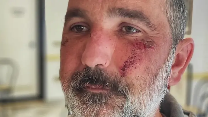 Francesco Sorgon di Cavaso del Tomba aggredito dopo essere stato invitato a un appuntamento