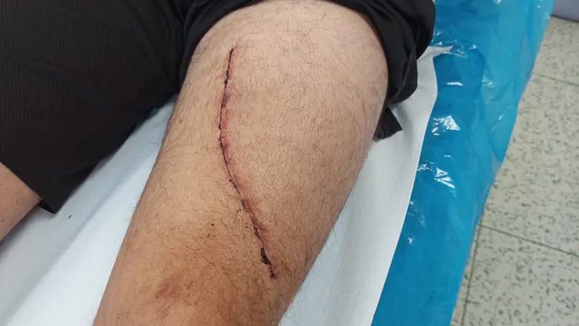 La ferita sulla gamba del giovane