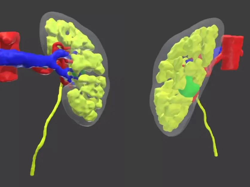 Il modello tridimensionale del rene del paziente con il tumore