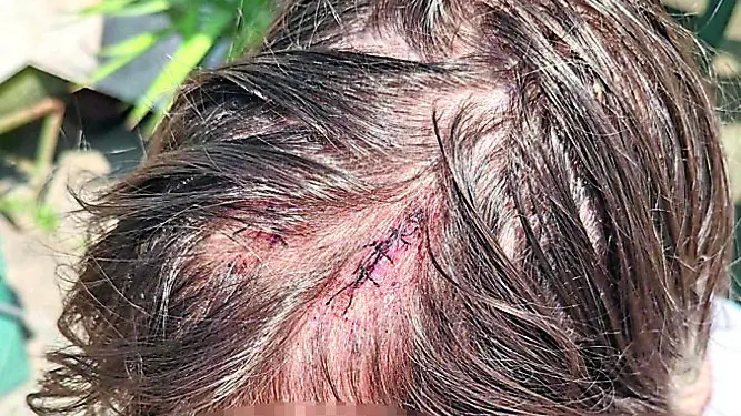 Il cassiere 22enne mostra le ferite al capo causate dalla scatoletta di tonno