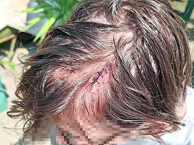 Il cassiere 22enne mostra le ferite al capo causate dalla scatoletta di tonno