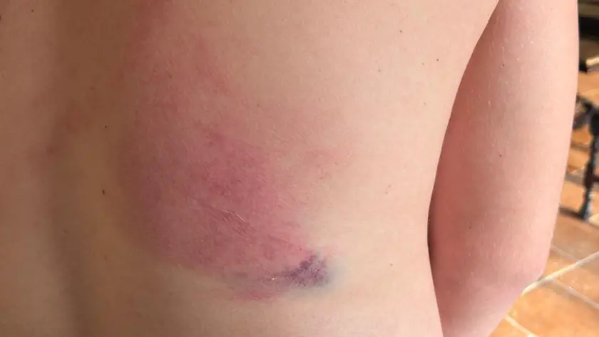 I segni dei colpi ricevuti dall'edicolante durante la colluttazione