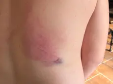 I segni dei colpi ricevuti dall'edicolante durante la colluttazione