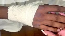 La mano fasciata del 21enne dopo la colluttazione