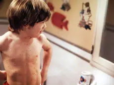 HOME ALONE 3 (US 1997) ALEX D. LIND ILLNESS: CHILD MEASLES Date: 1997