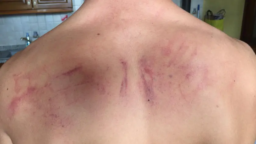 I segni delle violenze patite sulla schiena del ragazzo
