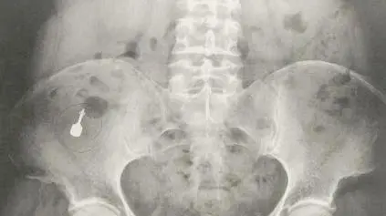 La radiografia mostra dove si era fermato il cacciavitino