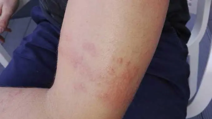 I segni rimasti sul braccio del doloroso contatto in mare con una medusa a Jesolo