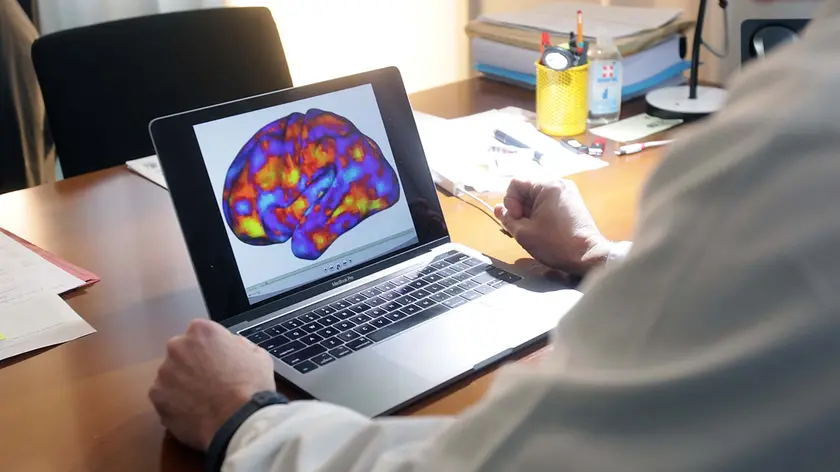 La sopravvivenza in tumore cerebrale dipende da connessioni. La scoperta a Padova