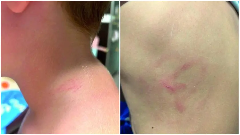 I segni sul collo e sul corpo del dodicenne dopo l’aggressione del custode